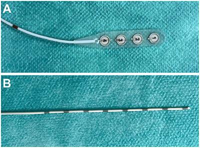 Less-invasive subdural electrocorticography for investigation of spreading depolarizations in patients with subarachnoid hemorrhage